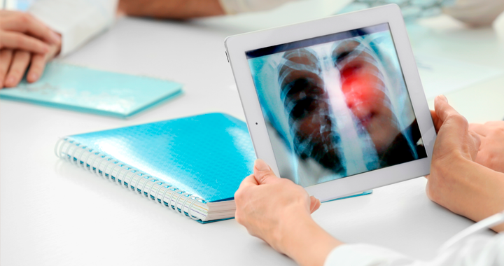 Cáncer de pulmón: la enfermedad más mortal por cáncer